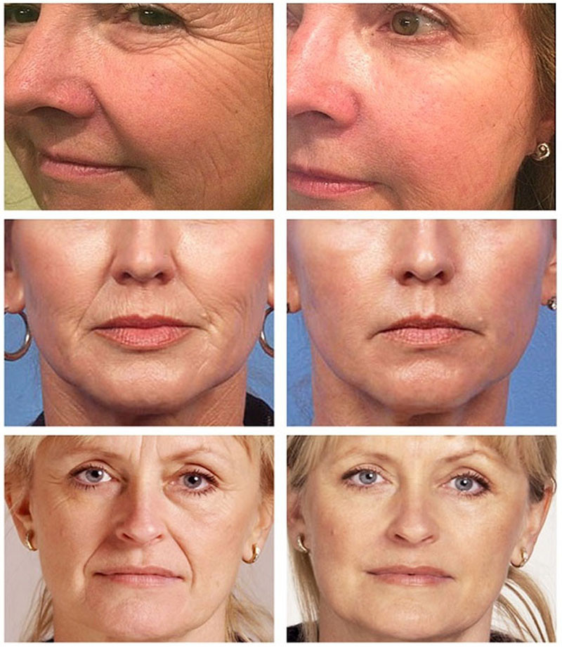 Rimozione delle rughe Siero istantaneo Anti invecchiamento Dissolvenza Linee sottili Essenza rassodante Riparazione Nutrire Illuminare la cura della pelle coreana_voghion.com
