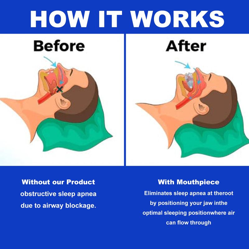 EELHOE Anti-snarkningstöd Förebygger snarkning Motverkar tandgnissling Mjuk andning Tandskydd Anti-snarkningstöd och skyddande stöd_voghion.com