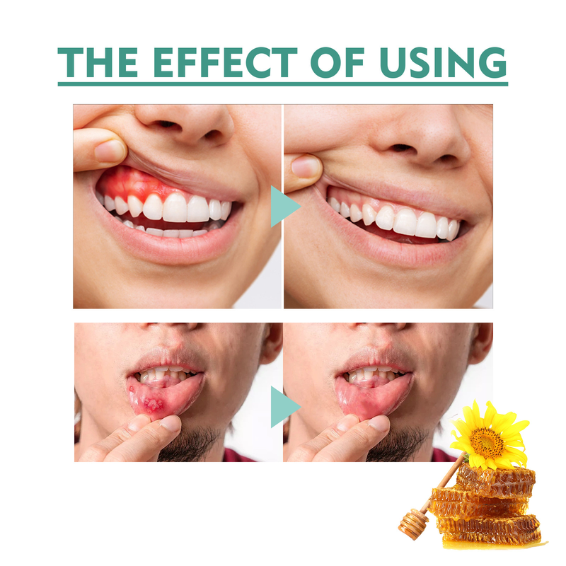 Lindring vacker oral spray för att lindra aftös brännande och blåsor tandköttssmärta Oral Care Spray_voghion.com