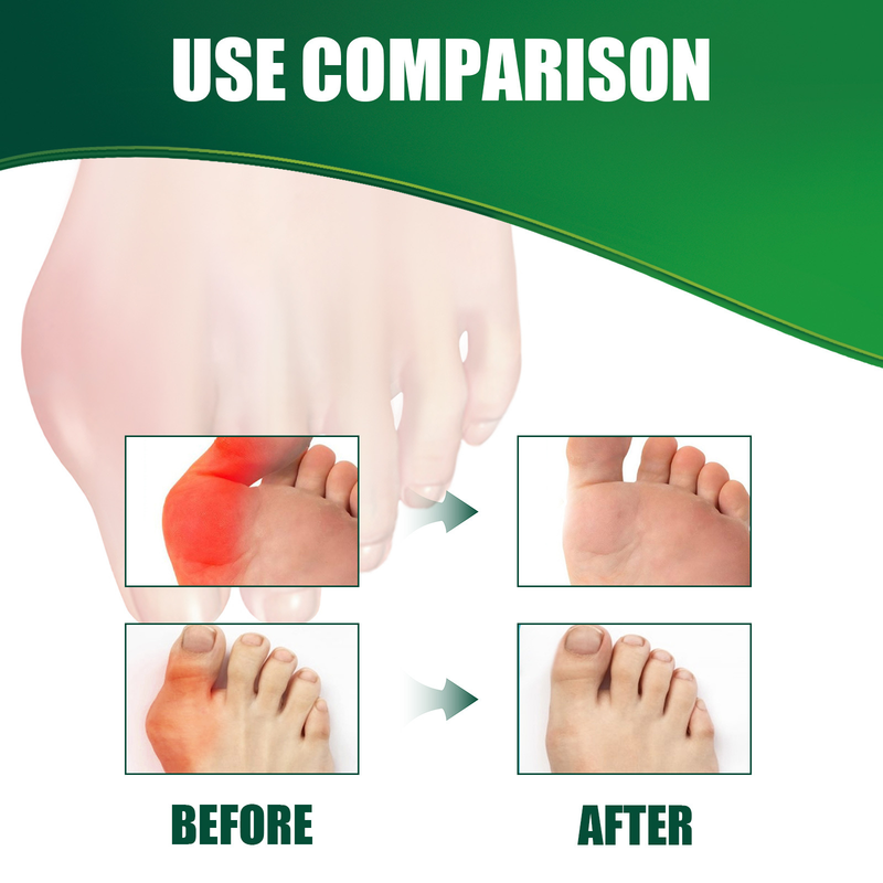 thumb bursitis Beautiful relief patch for thumb valgus big foot bone bursitis valgus double toe care patch_voghion.com