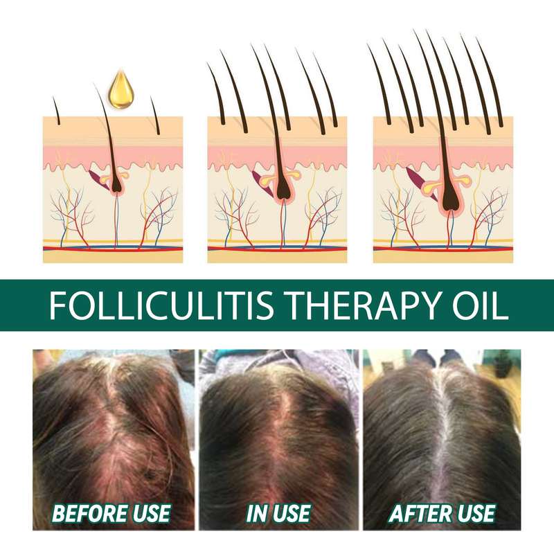 soins capillaires Huile essentielle du cuir chevelu pour un nettoyage en profondeur et la réparation des racines des cheveux, soulageant les démangeaisons, prévenant la perte de_voghion.com