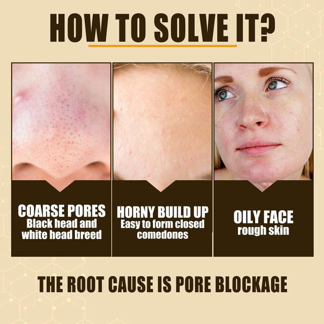 Pore Shrinking Serum Salisylsyre Frukt Acid Essence Glatte porer Anti Aldring Bghten Whitening Fuktighetsgivende hudpleieprodukt 30ml_voghion.com