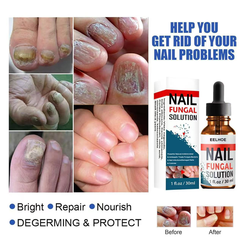 EELHOE 30ml Anti Fungus Liquid Toe Finger Nail Infection Repair Treatment_voghion.com