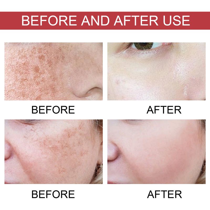 Hoygi Dark Spots Repair Essence, Feuchtigkeitsspendend an ophellend Reparaturessenz fir donkel Flecken an Altersflecken_voghion.com