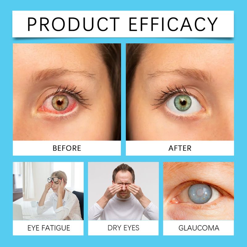 Ximonth Eye Care Drops Gentle Care For Eye Skin Refreshing And Moisturizing Portable Eye Drops_voghion.com