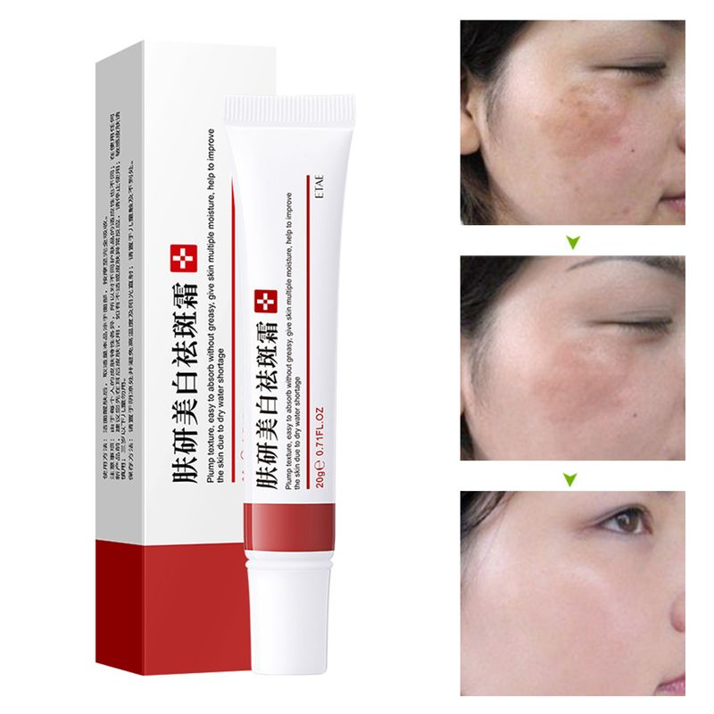 Hislaves 20 g Makel-Entfernungsgel, aufhellende, nicht reizende Hautpflege, Korrektur dunkler Flecken, Entferner, Aufhellungscreme für Mädchen, 20 g_voghion.com