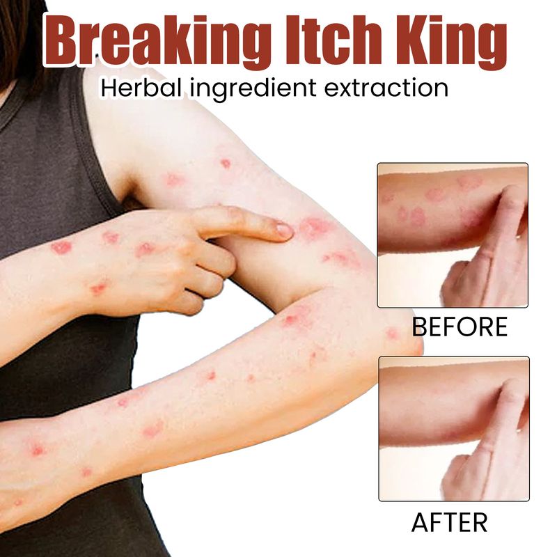 Crema antipruritus para aliviar el enrojecimiento de manos y pies, reparación de musgo, picazón, crema para el cuidado de la piel de South Moon_voghion.com