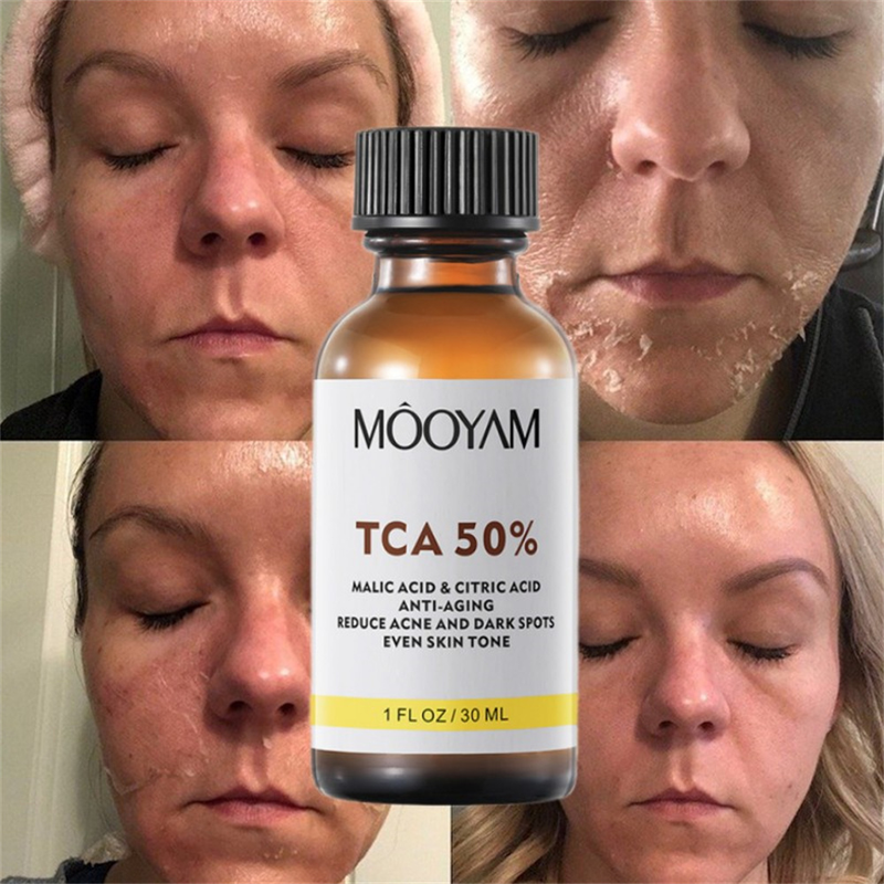 Hoge Kwaliteit TCA 50% Chemische Peel Tca Peel Zure Huid Superforce Peel Pigmentatie Lightening Melanine Acne Behandeling Litteken verwijderen_voghion.com