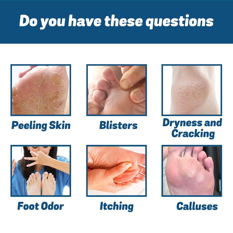 Ximonth Medizinisches Nagelpilz-Fußspray, Reparatur, Verdickung, graue Nagelfäule, feuchtigkeitsspendende und reinigende Fußpanzerung_voghion.com