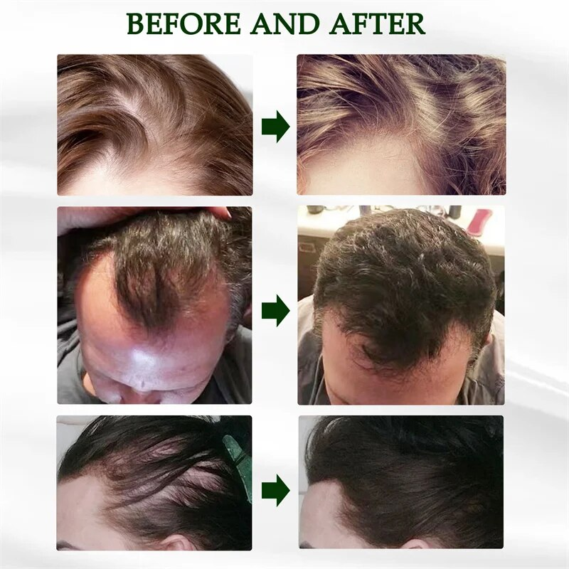 Ginger Fast Hair Growth Serum Spray Regrowth Essence Oil Hiustenlähtöä estävät tuotteet ehkäisevät kaljuuntumista Päänahan hoito Kauneus terveys_voghion.com