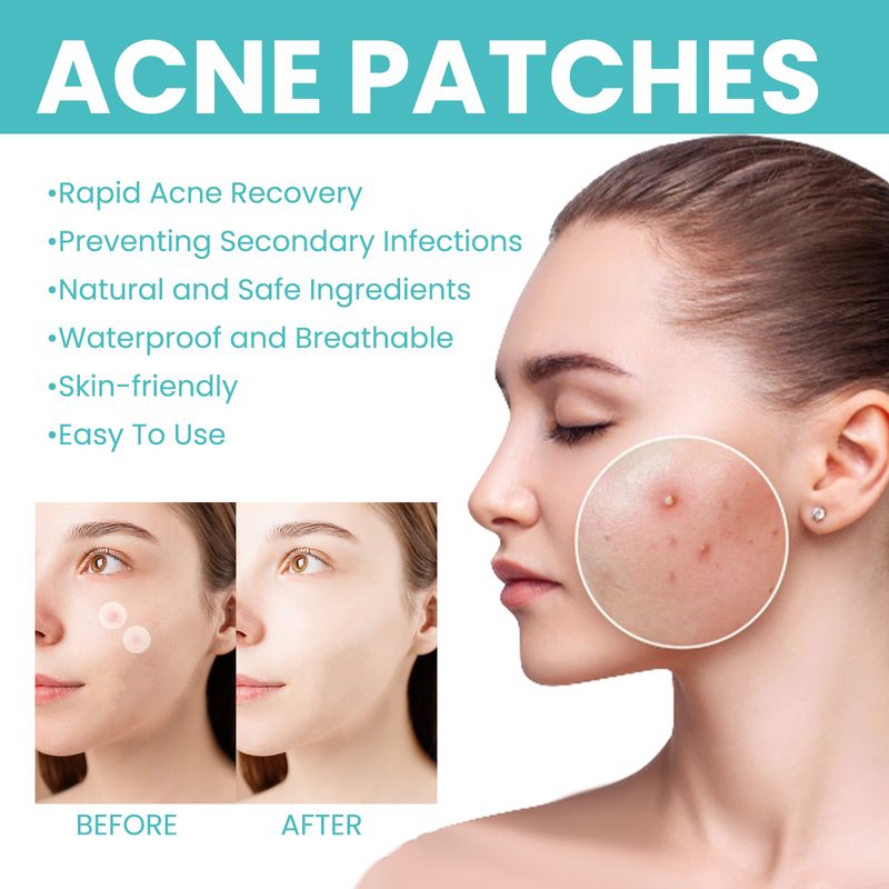 West&Month Acne Patch (300pcs) Repairs Acne And Blackheads, Cleans Pores, Is Invisible, Breathable, Concealer And Waterproof_voghion.com