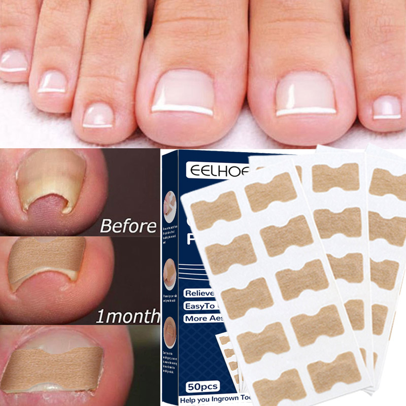 Boutique de soins de beauté Autocollants correcteurs pour ongles incarnés 50 pièces Patchs correcteurs pour ongles incarnés Traitement pour paronychie Recover Co_voghion.com