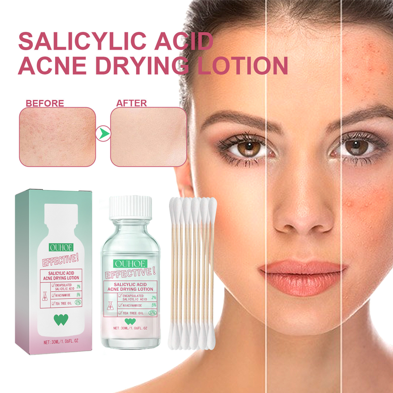 Salicylic Acid Acne Removal Serum Pimples Treatment Anti Whiteheads Oil Control Shrinking Pores Moisturizing Cleansing Skin Care Face care_voghion.com