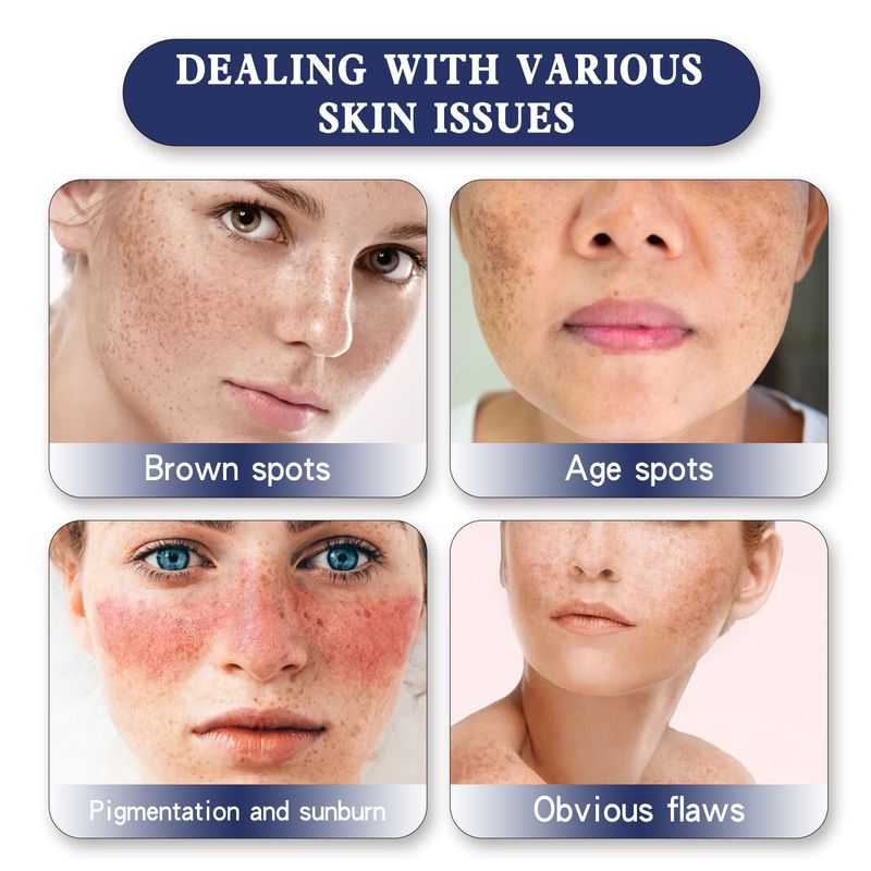 Crema schiarente Hoygi Skin Genesis Spot Whitening Cream, diluire le macchie, pelle liscia e colore bianco brillante. Questa delicata crema idratante per la pelle._voghion.com