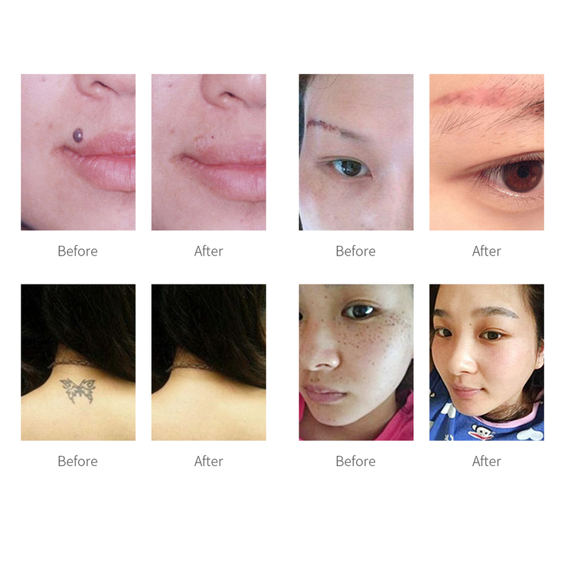 Picosecond Pen Laser Tattoo Removal Whitening Skin Mole Freckles Wart Dark Spot Remover with Facial Gel_voghion.com