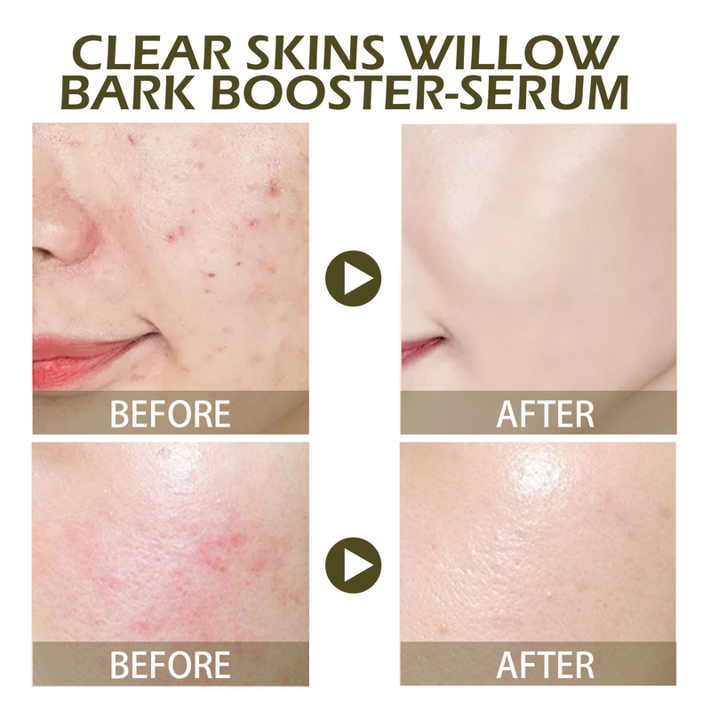 EELHOE Cleansing Willow Bark-essentie kan de droogheid verlichten, acnevlekken vervagen, de huid reinigen, hydrateren en een gevoelige huid veroorzaken_voghion.com