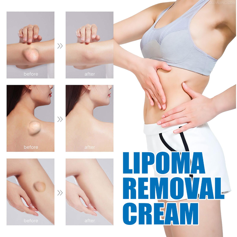 1tk Lipoomi ravikreem Lipolüüsi eemaldamine Nahakasvaja Turse Valu Salv Plaast Leevendus Kooriv Tselluliit_voghion.com