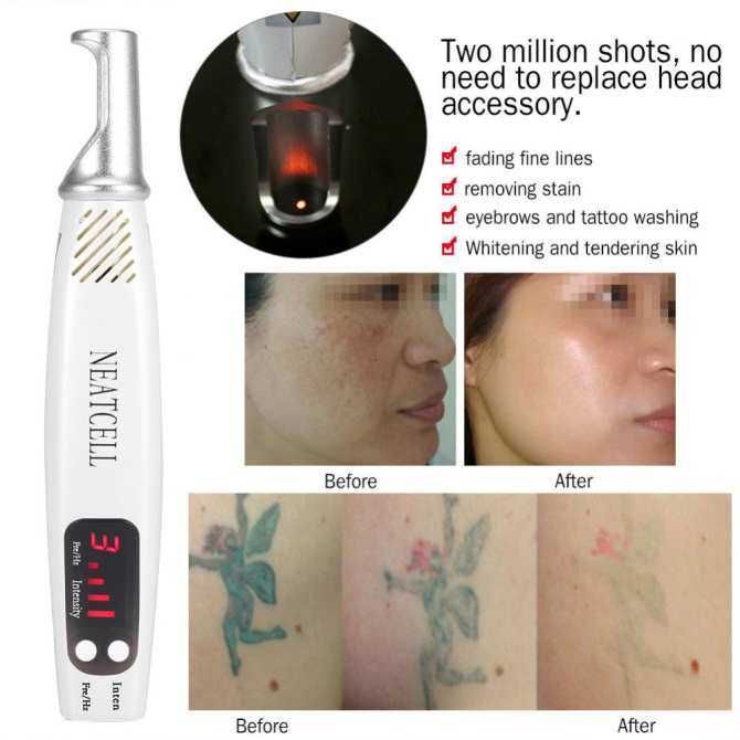 Stilo cu laser Picosecundă cu lumină roșie manuală pentru îndepărtarea cicatricelor tatuaje Dispozitiv de diluare a melaninei + Set de reparații - intl_voghion.com