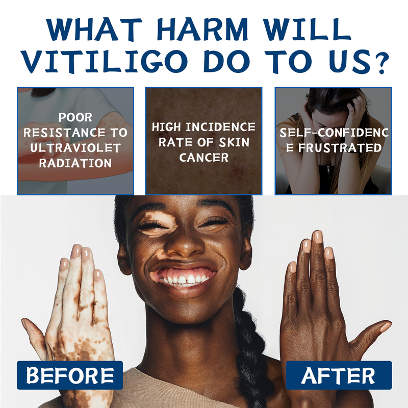 Reparatie Mooie Whitespot Cream voor het verlichten van witte vlekken, bloemvlekken, zweetvlekken Huidreparatie, verenigende huidskleur,_voghion.com