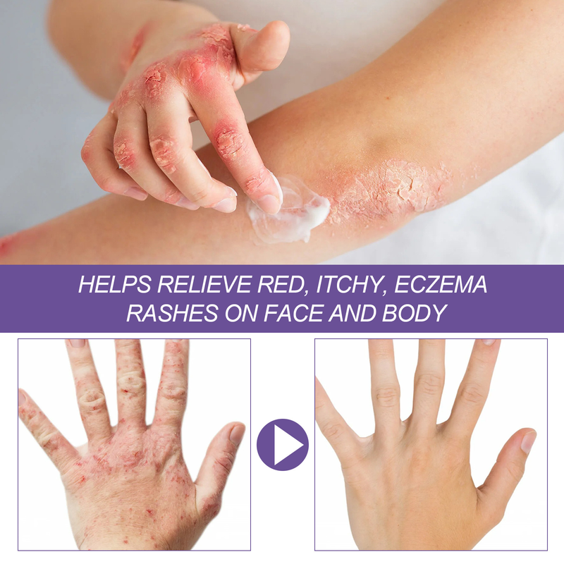 EELHOE Skin Repair Cream käte jalasambla parandamiseks, sügeluse ja punetuse leevendamiseks ning niisutav nahahoolduskreem_voghion.com