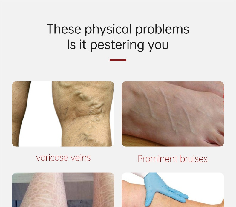 AUQUEST Venous per la corrosione vascolare, colla, gonfiore dei piedi, sollievo dal dolore alle gambe dei lombrichi, crema Zhang curva_voghion.com