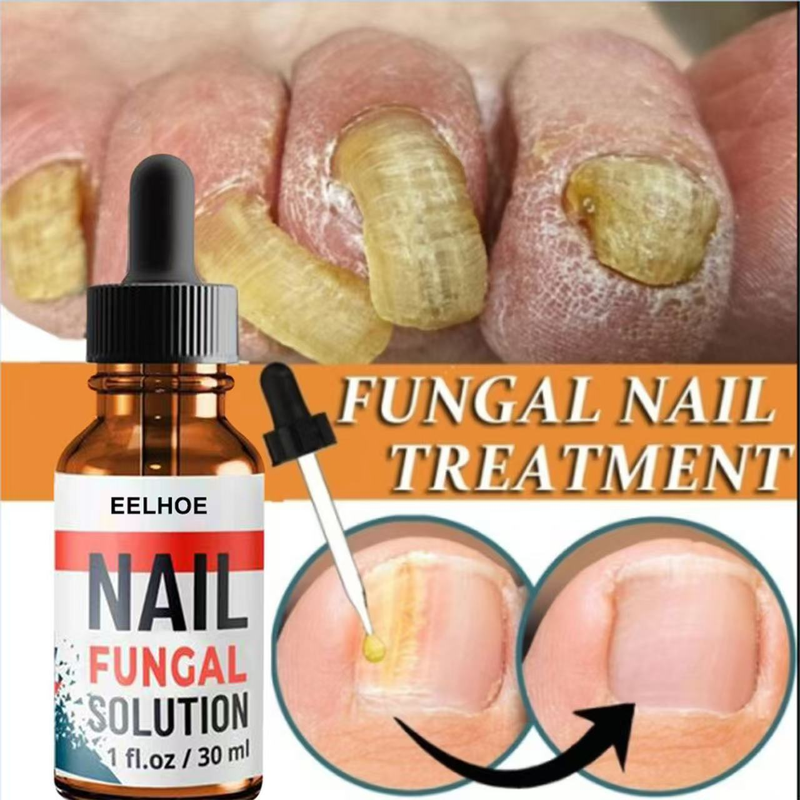 EELHOE 30ml Anti Fungus Liquid Toe Finger Nail Infection Repair Treatment_voghion.com