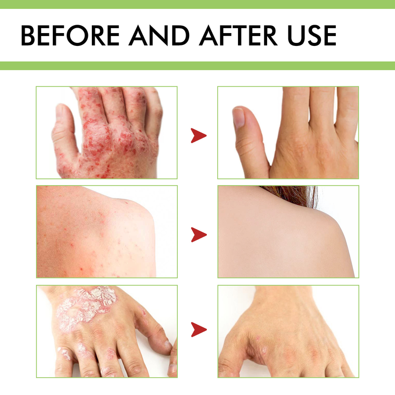 South Moon Skin Cream, itchy, itchy, sensitive, red, itchy, antibacterial topical cream_voghion.com