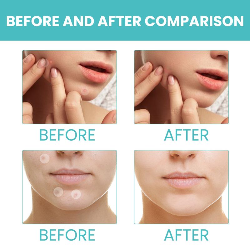 West&Month Acne Patch (300pcs) Repairs Acne And Blackheads, Cleans Pores, Is Invisible, Breathable, Concealer And Waterproof_voghion.com