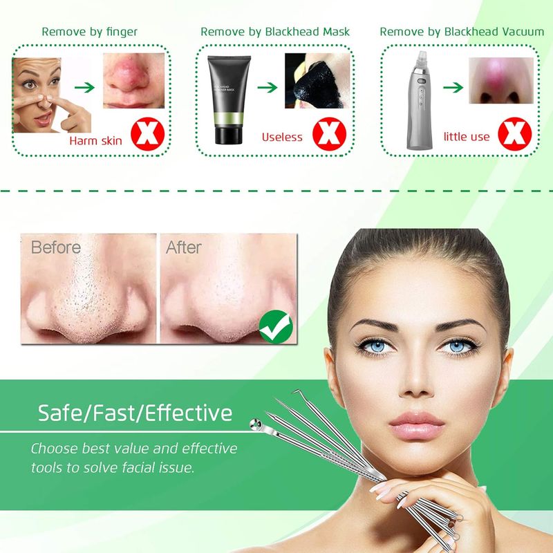 5 estrattori di comedoni, kit di pinzette curve per punti neri, kit di strumenti professionali in acciaio inossidabile per la rimozione dell'acne_voghion.com
