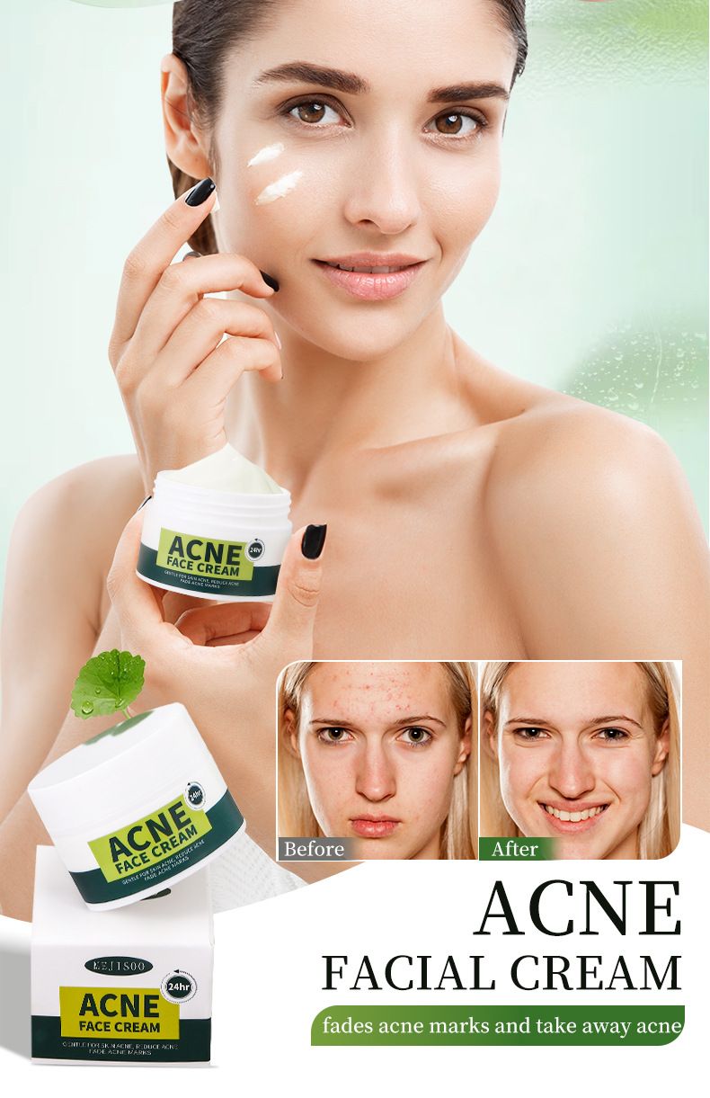 Treatments & Masks Anti Acne Facial Cream Moisturizing And Rejuvenating Acne Cream Facial Care_voghion.com