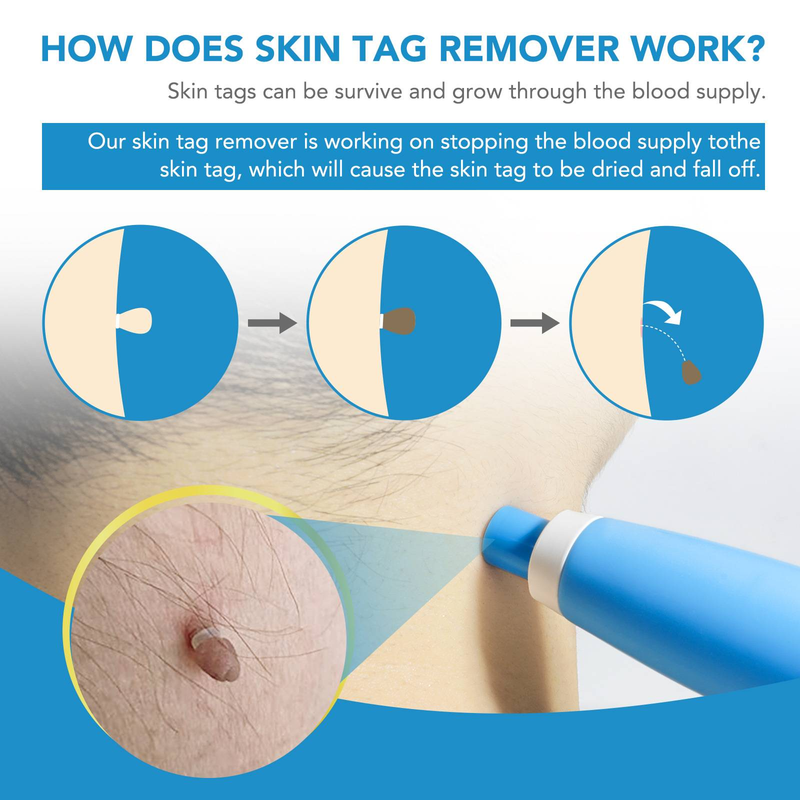 Skin Tag Remover Kit, Body Tag Remover, Pijnloos, veilig, snel en effectief, Auto Skin Tag Remover _voghion.com
