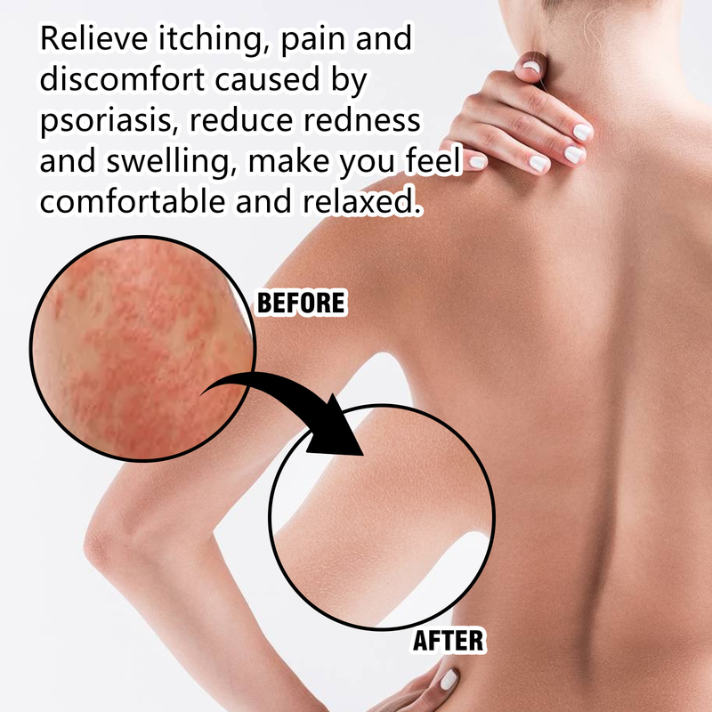 XIMONTH Repair Repairs redness itching of hands and feet Skin Care spray_voghion.com