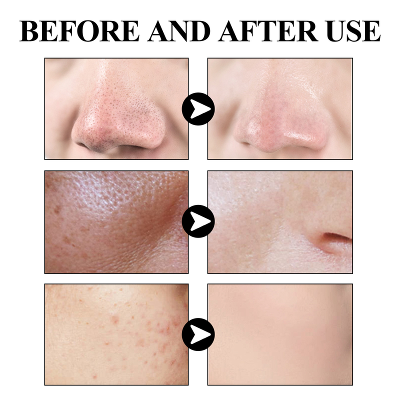 Schrumpfen Schöne poren schwarz gesichts maske für tiefe reinigung poren, mitesser, mund schließen, akne, zart und glatt, köpfe,_voghion.com