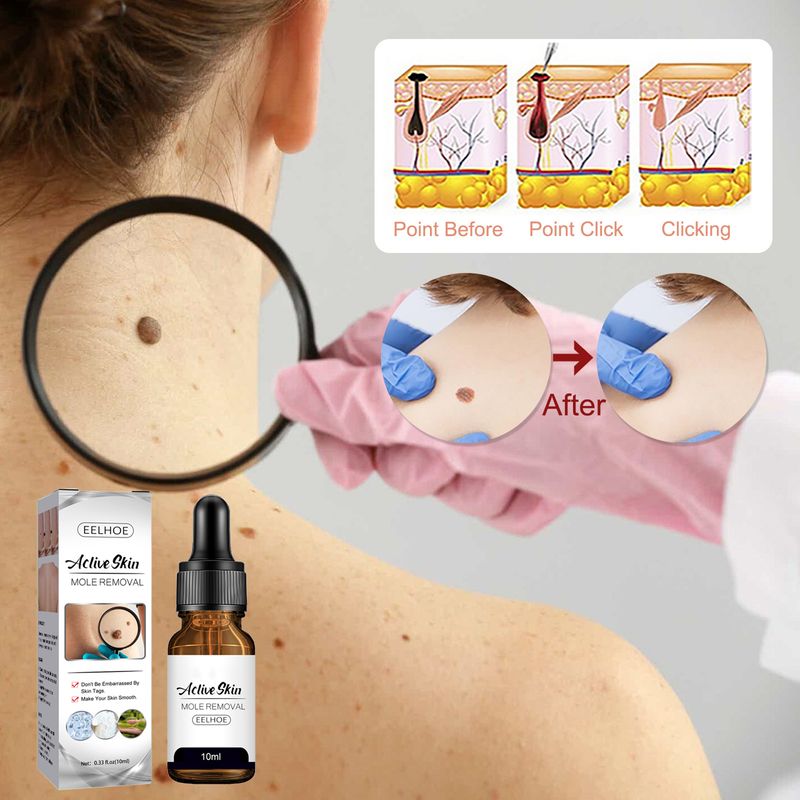 10 ml Behandlung zur Hühneraugenentfernung, tiefes Eindringen, gesunde, multifunktionale Essenz zur Entfernung von Hautmalen für Mädchen_voghion.com