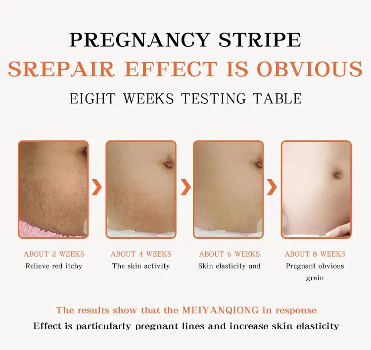 QLZHANFU Crème d'élimination permanente des vergetures de maternité Estompe les ridules Femmes enceintes Réparation des cicatrices Lifting de la peau Ferme Grossesse Soins du corps_voghion.com