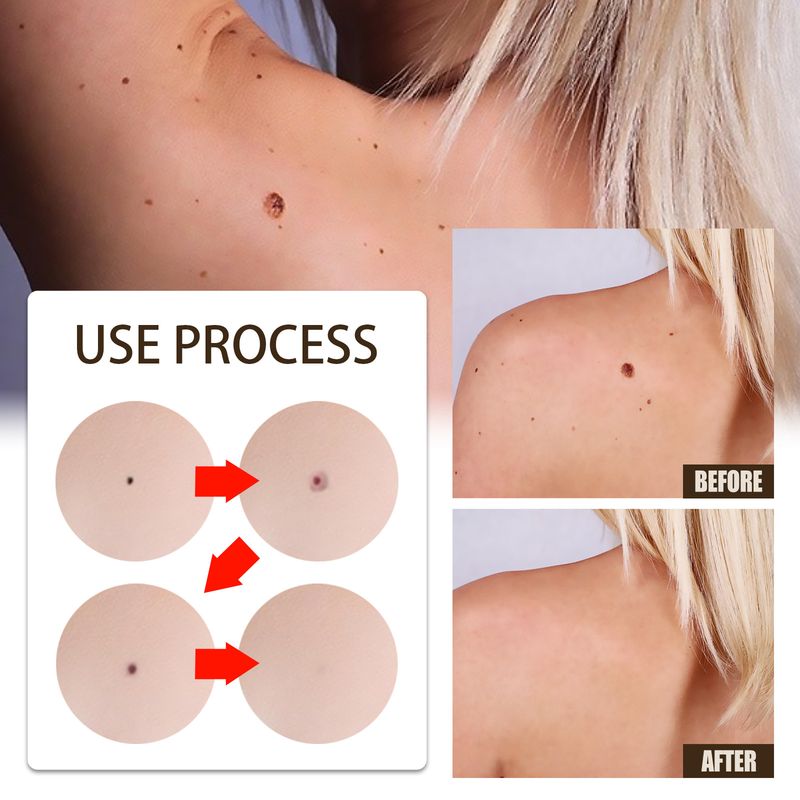 EELHOE Cilt Temizleme Nevus Siğil Giderici Merhem El, Ayak, Yüz, Koltukaltı Et Granülleri Boyun Bakım Kremi_voghion.com