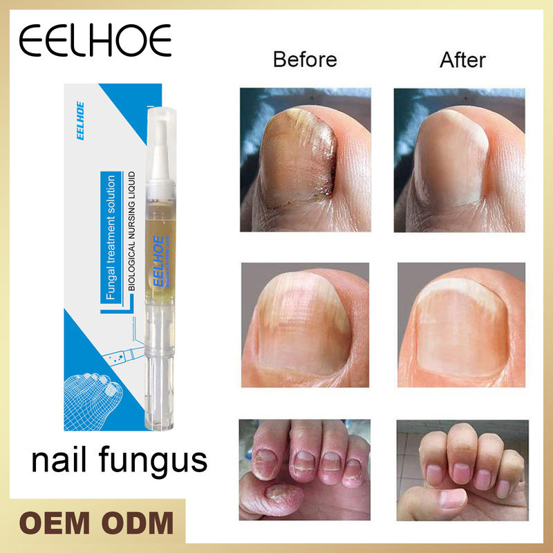 Nail Repair Beautiful Liquid Hand and Foot Grey Nail Care Repair Grey Nail Liquid Thickens Soft Nails s_voghion.com