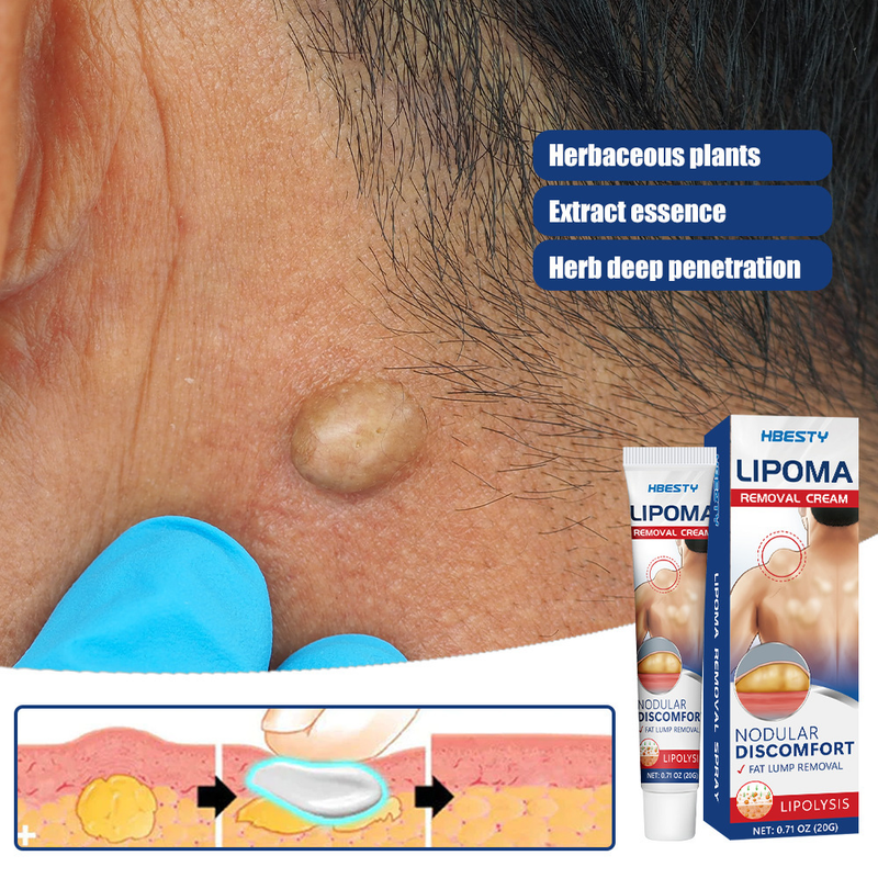 Knot Eliminating HBESTY Cream Relieving Subcutaneous Bulging of Fat Lumps and Granules_voghion.com