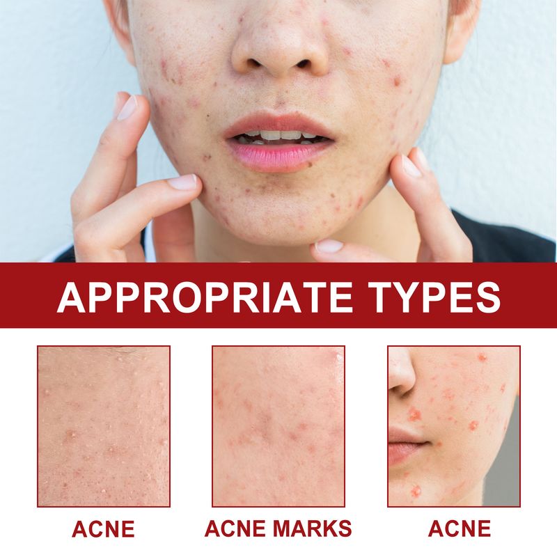 OUHOE Facial Care Acne Patch, Gently Clean And Reduce Acne Skin Soft Smooth Multi-Shape Portable Acne Patch_voghion.com