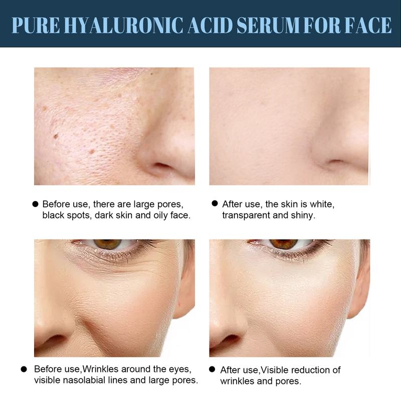 Linea proteica Collagene Assorbibile Lifting Filo Antirughe V-face Lifting Rassodante Schiarente Linee sottili Filler Viso Anti-invecchiamento_voghion.com