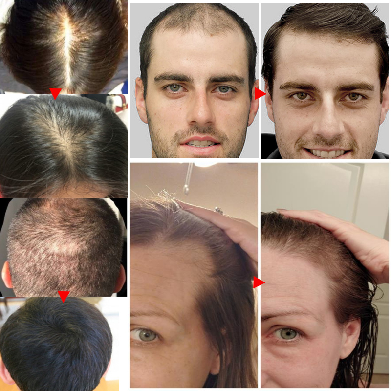 Ingwer-Haarwuchsspray-Produkte, natürliches Anti-Haarausfall-Serum, verhindern Haarausfall, Behandlung, schnelles Wachstum, nähren geschädigtes Haar_voghion.com