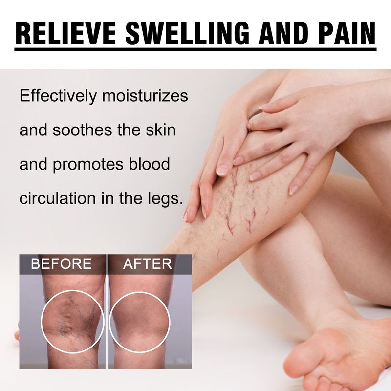 Ximonth Soulagement de la douleur, du gonflement et de l'inconfort dans les jambes dus aux tendons bleus, crème de soin de massage veineux_voghion.com