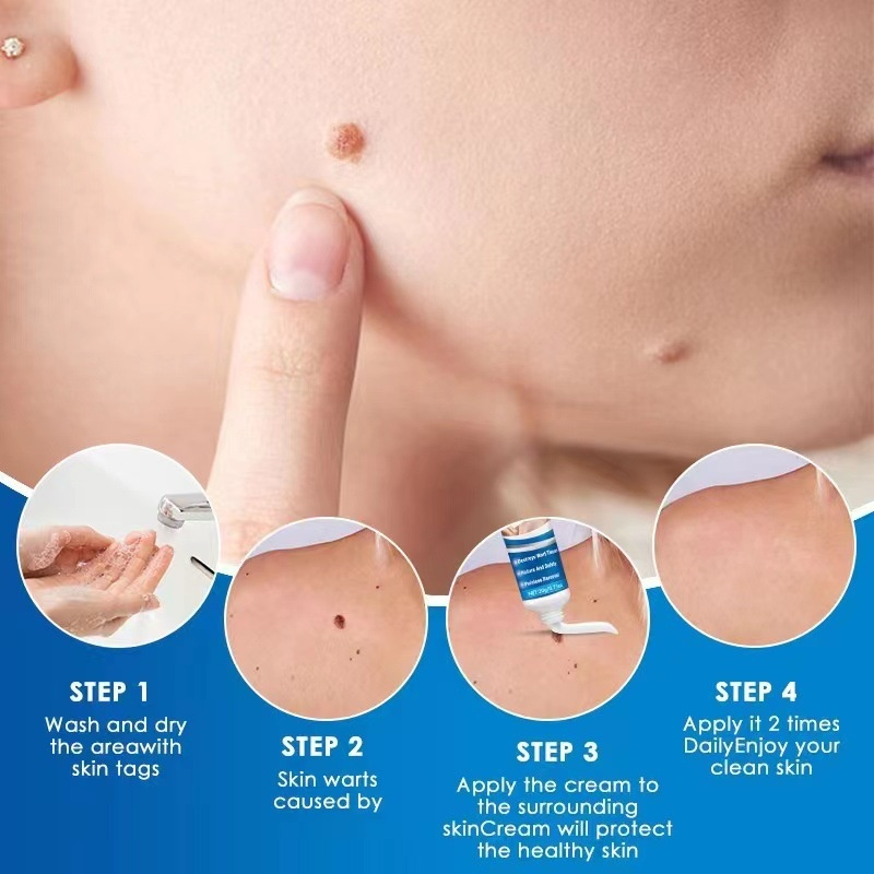 SOL LORA Yama Flat Removal Filamentous Wart Chicken Eye Spot Nevus Cream_voghion.com