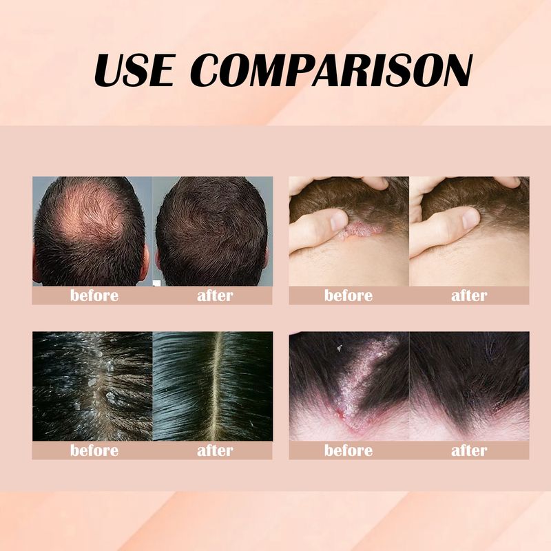 EELHOE Hair Nourishing Essence Daily Clean Scalp Dandruff Refreshing Oil Control Moisturizing Care Soft And Beautiful_voghion.com