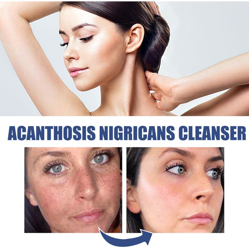 OUHOE Sort, tornet hudrens til dybderensning, blødgøring, reparation, oliekontrol og rensning af ansigtet_voghion.com