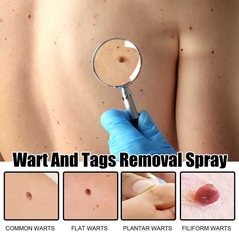 Spray Ximonth pentru îndepărtarea negilor și a alunițelor, curăță și estompează alunițele, spray reparator neted pentru piele_voghion.com