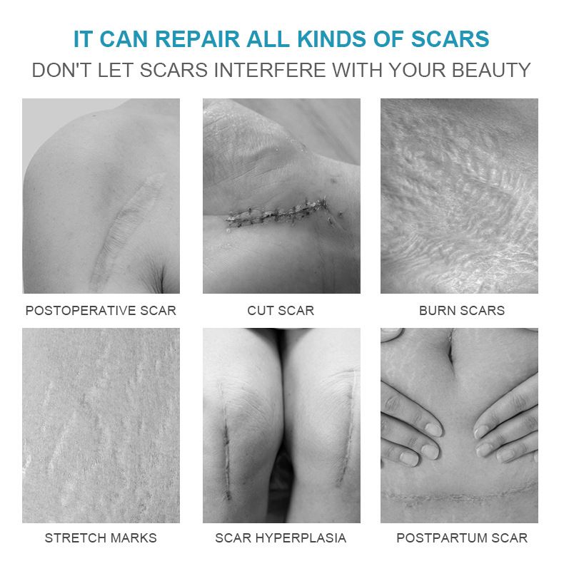 2025 Popular Cream Desalination Scar Cream Ointment Cold Compress Gel Smooth Repair_voghion.com