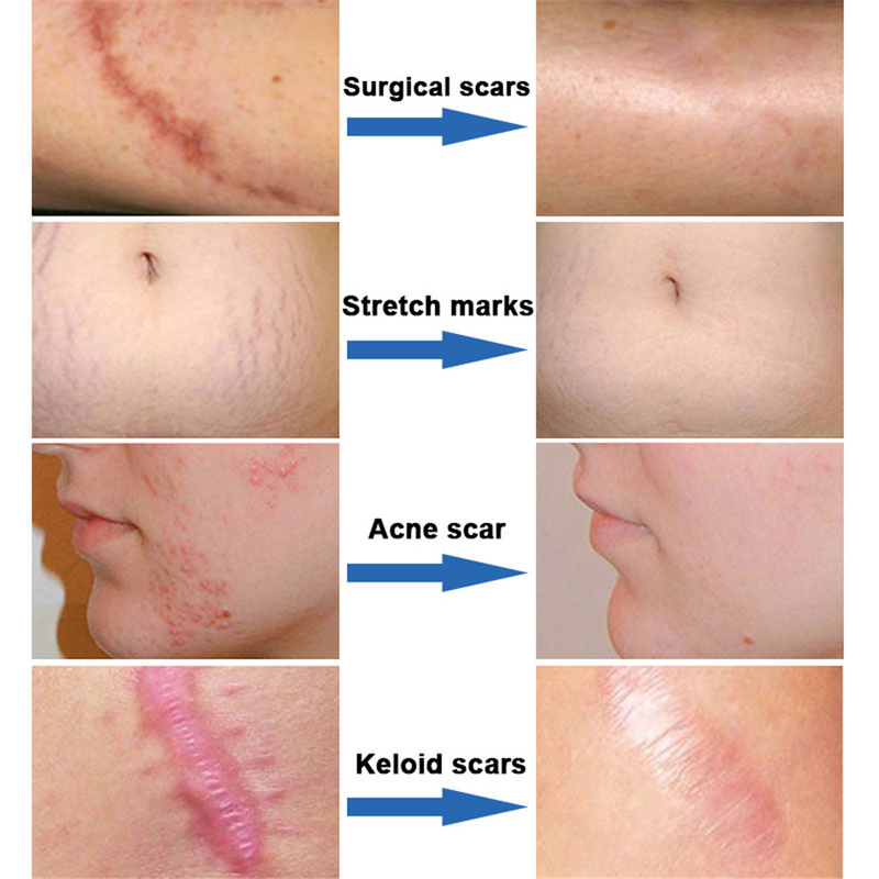 QLZHANFU Crème avancée d'élimination des cicatrices Boutons d'acné Réparation des vergetures Gel Brûlure Traitement chirurgical des cicatrices Lissage Beauté du corps Soins de la peau_voghion.com