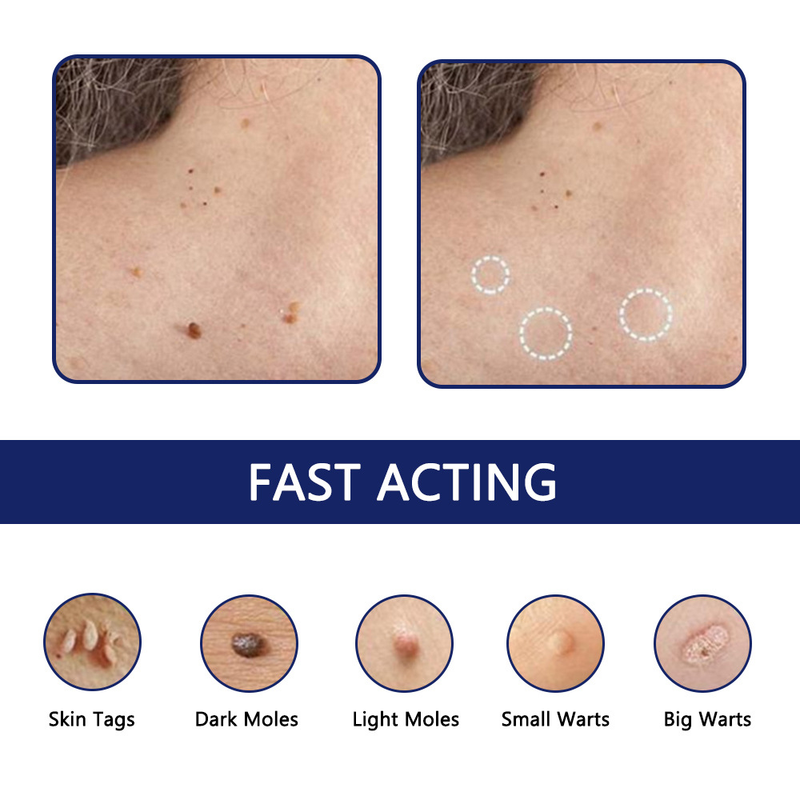 New Skin Tag Remove Wart Treatment_voghion.com