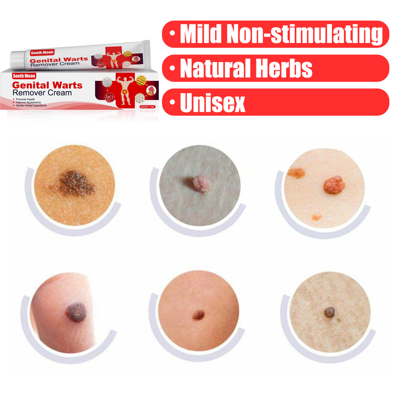 South Moon Pinghou Youke Wart Cream can suppress warts on hands, feet, face, armpits, and neck._voghion.com